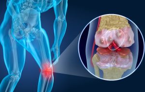 Diz Agrisi Nedir Diz Agrisina Ne Sebep Olur