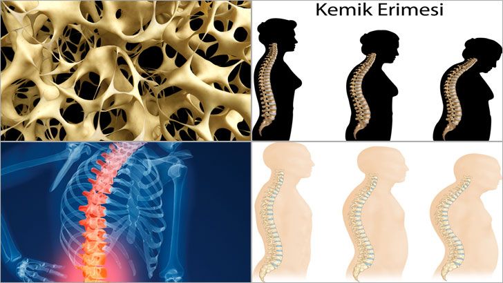 Osteoporoz (Kemik Erimesi) Nedir? Osteoporoz Belirtileri Nelerdir? Nasıl Tedavi Edilir? Osteoporoz Belirtileri