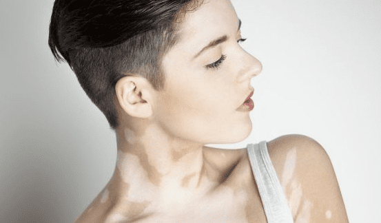 Vitiligo (Ala) Hastalığı İçin Bitkisel Çözümler, Sarımsak ve Tuz Karışımı Vitiligo Kürü Vitiligo nasıl geçer