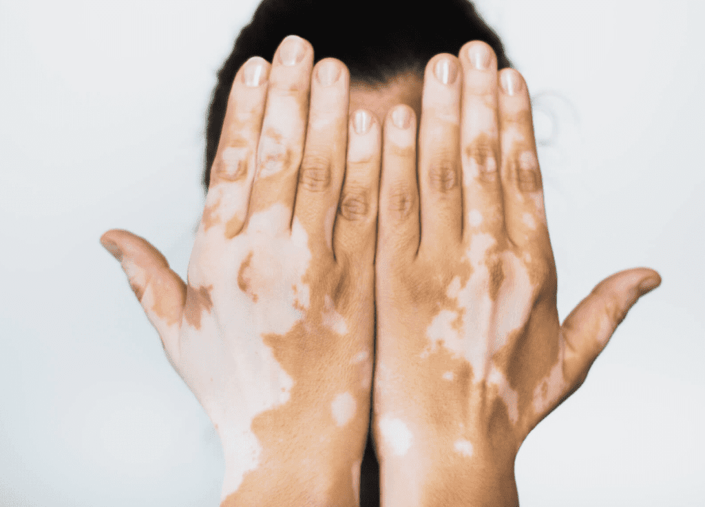 Vitiligo neden olur