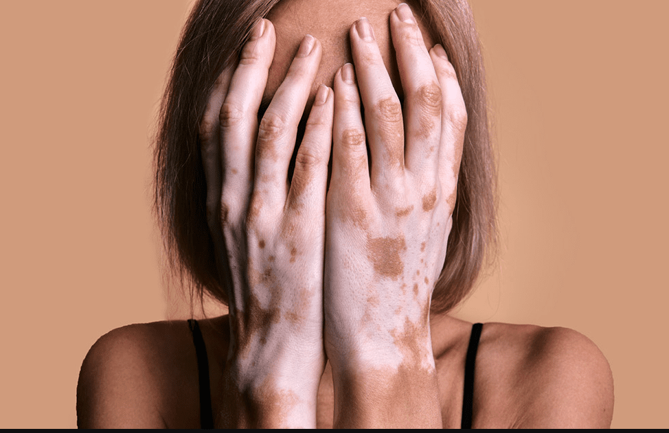 Vitiligo tedavisi bitkisel çözümler