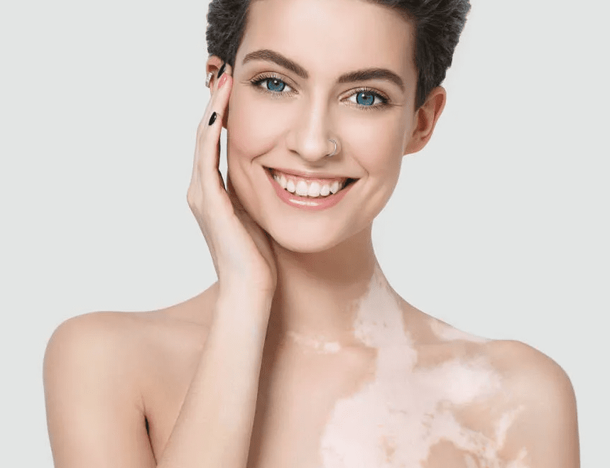Vitiligo (Ala) Hastalığı İçin Bitkisel Çözümler, Sarımsak ve Tuz Karışımı Vitiligo Kürü vitiligo hastalığı nedir